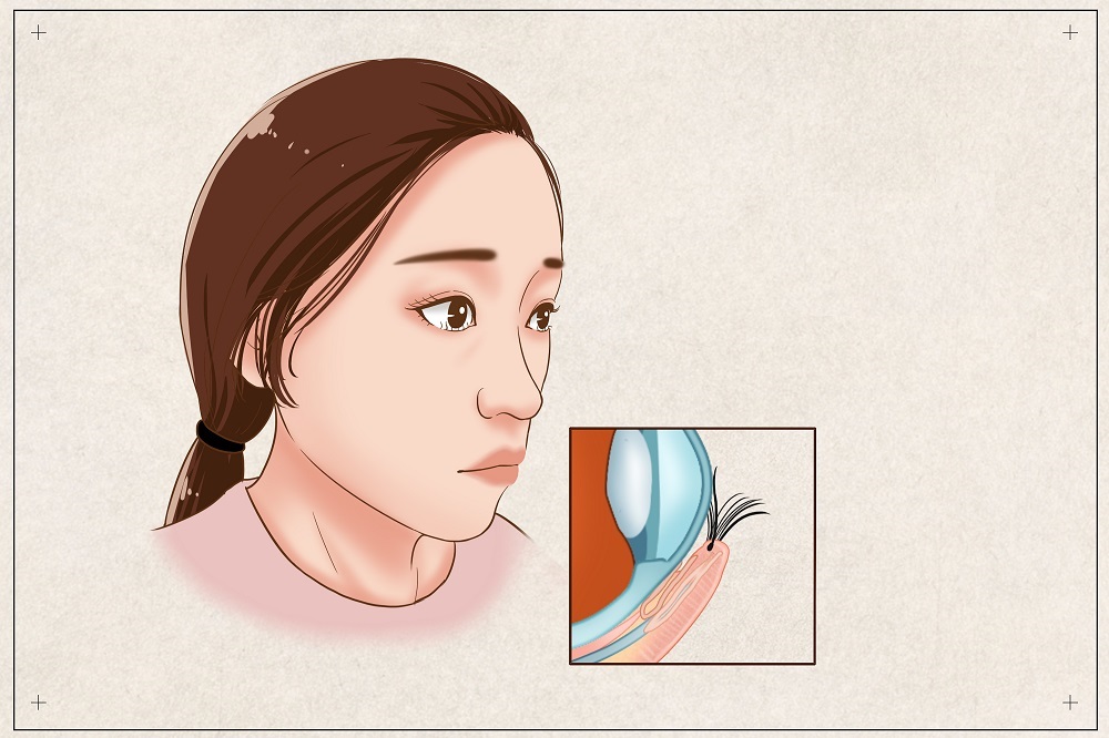 倒睫會自己好嗎？